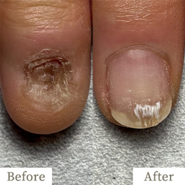 - トレフル|明石の深爪矯正ネイルサロン