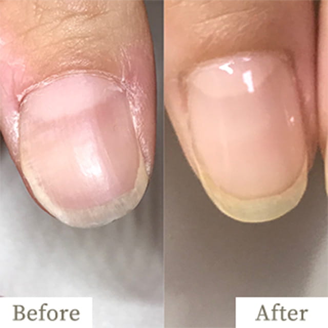 ba-img11 - トレフル|明石の深爪矯正ネイルサロン 明石市の深爪矯正専門サロン|深爪・噛み爪・むしり癖でお悩みならトレフル