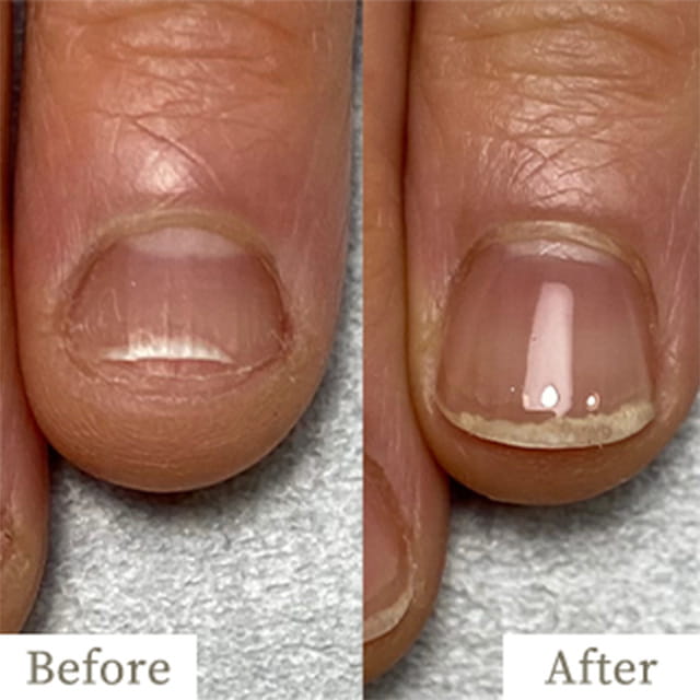 ba-img13 - トレフル|明石の深爪矯正ネイルサロン 明石市の深爪矯正専門サロン|深爪・z噛み爪・むしり癖でお悩みならトレフル