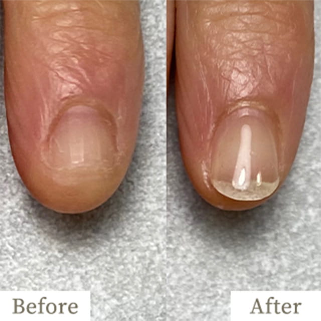 ba-img14 - トレフル|明石の深爪矯正ネイルサロン 明石市の深爪矯正専門サロン|深爪・z噛み爪・むしり癖でお悩みならトレフル