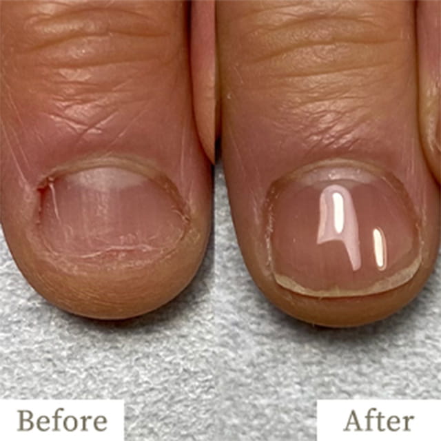 ba-img15 - トレフル|明石の深爪矯正ネイルサロン 明石市の深爪矯正専門サロン|深爪・z噛み爪・むしり癖でお悩みならトレフル