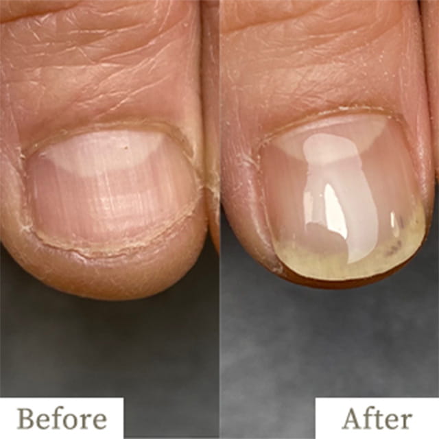 ba-img16 - トレフル|明石の深爪矯正ネイルサロン 明石市の深爪矯正専門サロン|深爪・噛み爪・むしり癖でお悩みならトレフル