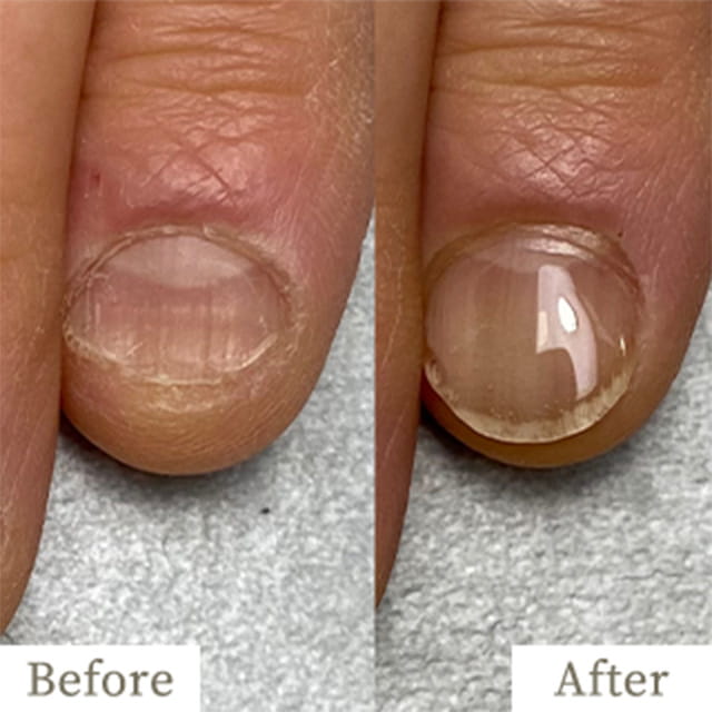 ba-img17 - トレフル|明石の深爪矯正ネイルサロン 明石市の深爪矯正専門サロン|深爪・噛み爪・むしり癖でお悩みならトレフル