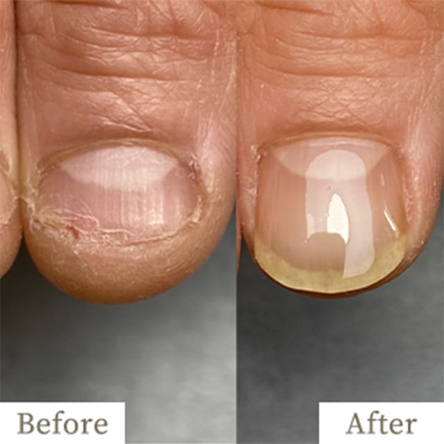 ba-img18 - トレフル|明石の深爪矯正ネイルサロン 明石市の深爪矯正専門サロン|深爪・噛み爪・むしり癖でお悩みならトレフル