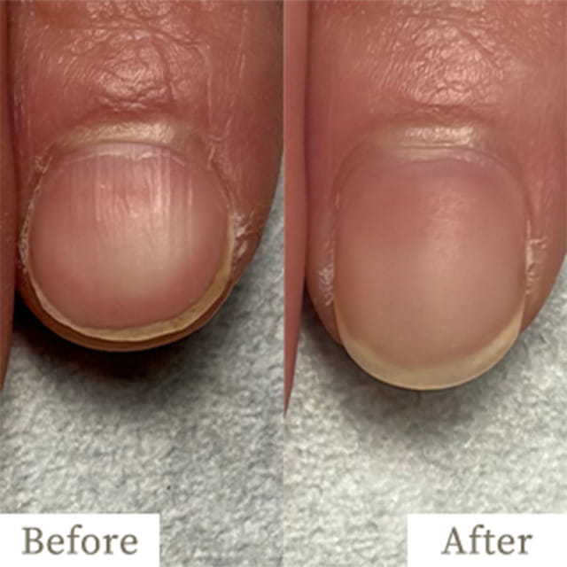 ba-img19 - トレフル|明石の深爪矯正ネイルサロン 明石市の深爪矯正専門サロン|深爪・噛み爪・むしり癖でお悩みならトレフル