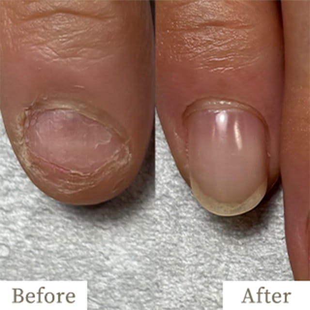 ba-img2 - トレフル|明石の深爪矯正ネイルサロン 明石市の深爪矯正専門サロン|深爪・噛み爪・むしり癖でお悩みならトレフル