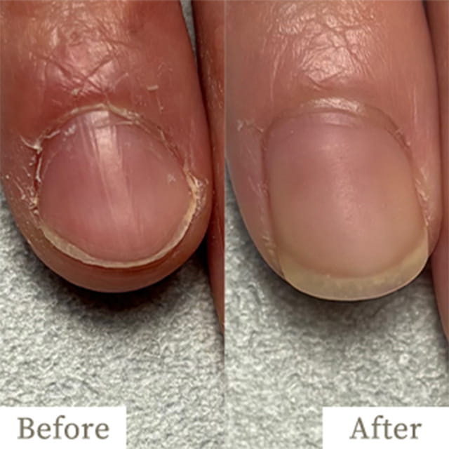 ba-img20 - トレフル|明石の深爪矯正ネイルサロン 明石市の深爪矯正専門サロン|深爪・噛み爪・むしり癖でお悩みならトレフル