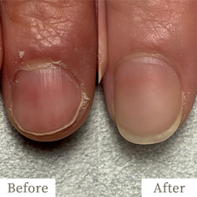 ba-img21 - トレフル|明石の深爪矯正ネイルサロン 明石市の深爪矯正専門サロン|深爪・噛み爪・むしり癖でお悩みならトレフル