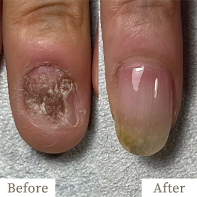 ba-img26 - トレフル|明石の深爪矯正ネイルサロン 明石市の深爪矯正専門サロン|深爪・噛み爪・むしり癖でお悩みならトレフル