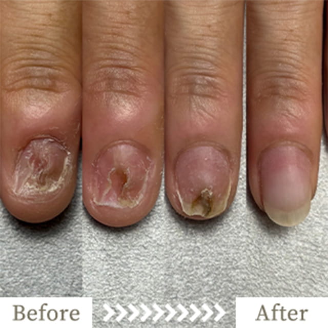 ba-img27 - トレフル|明石の深爪矯正ネイルサロン 明石市の深爪矯正専門サロン|深爪・噛み爪・むしり癖でお悩みならトレフル