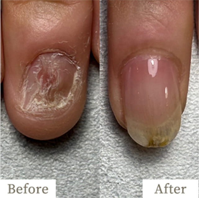 ba-img28 - トレフル|明石の深爪矯正ネイルサロン 明石市の深爪矯正専門サロン|深爪・噛み爪・むしり癖でお悩みならトレフル