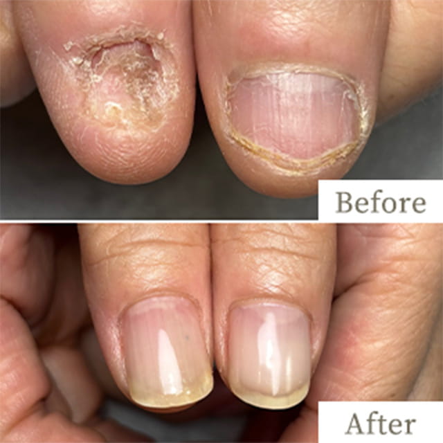 ba-img3 - トレフル|明石の深爪矯正ネイルサロン 明石市の深爪矯正専門サロン|深爪・z噛み爪・むしり癖でお悩みならトレフル