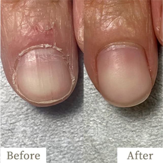 ba-img30 - トレフル|明石の深爪矯正ネイルサロン 明石市の深爪矯正専門サロン|深爪・噛み爪・むしり癖でお悩みならトレフル