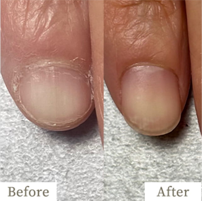 ba-img31 - トレフル|明石の深爪矯正ネイルサロン 明石市の深爪矯正専門サロン|深爪・噛み爪・むしり癖でお悩みならトレフル