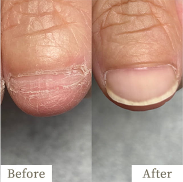 ba-img32 - トレフル|明石の深爪矯正ネイルサロン 明石市の深爪矯正専門サロン|深爪・噛み爪・むしり癖でお悩みならトレフル