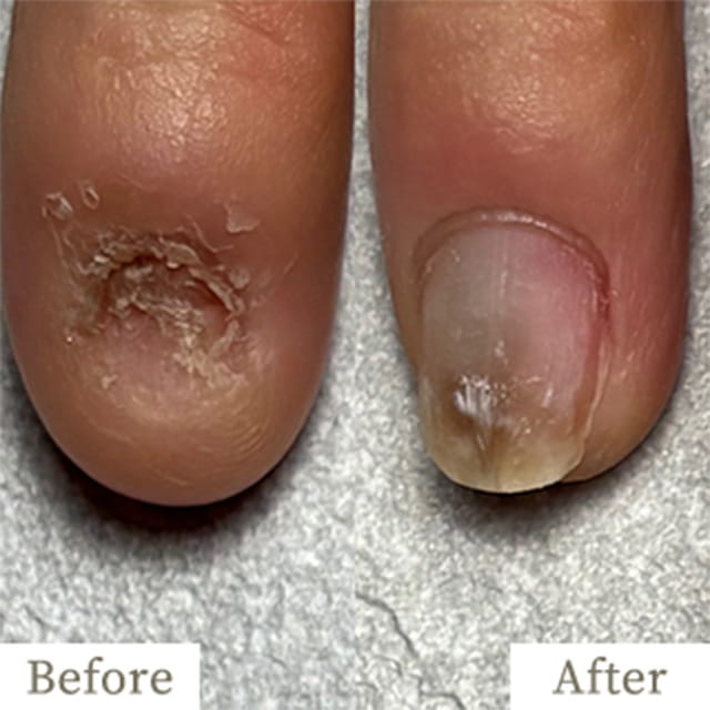 ba-img4 - トレフル|明石の深爪矯正ネイルサロン 明石市の深爪矯正専門サロン|深爪・噛み爪・むしり癖でお悩みならトレフル