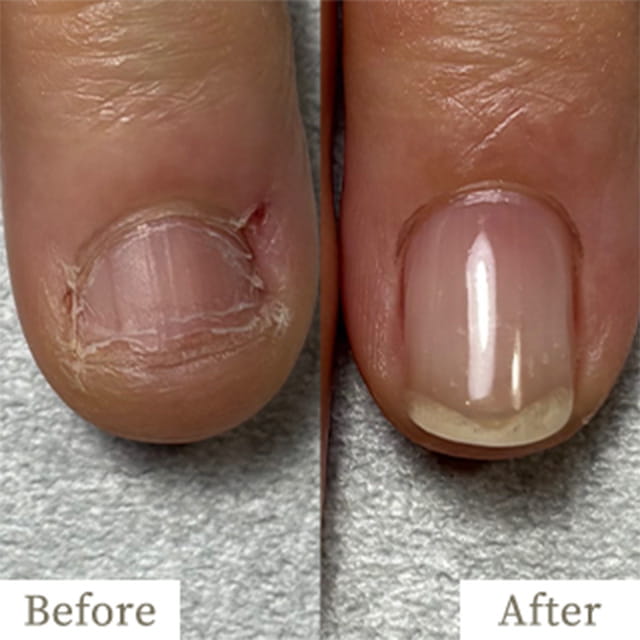 ba-img5 - トレフル|明石の深爪矯正ネイルサロン 明石市の深爪矯正専門サロン|深爪・噛み爪・むしり癖でお悩みならトレフル