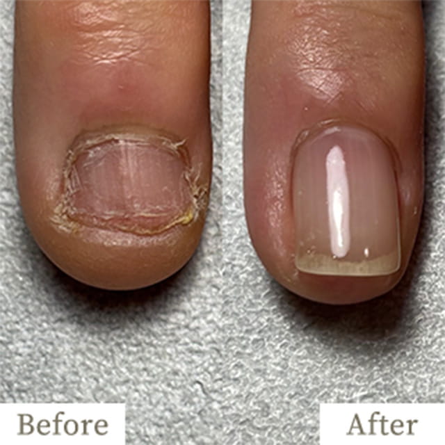 ba-img6 - トレフル|明石の深爪矯正ネイルサロン 明石市の深爪矯正専門サロン|深爪・噛み爪・むしり癖でお悩みならトレフル