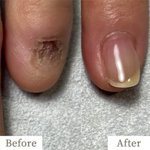 ba-img7 - トレフル|明石の深爪矯正ネイルサロン 明石市の深爪矯正専門サロン|深爪・噛み爪・むしり癖でお悩みならトレフル