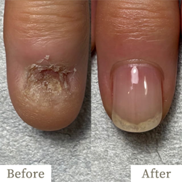 ba-img9 - トレフル|明石の深爪矯正ネイルサロン 明石市の深爪矯正専門サロン|深爪・噛み爪・むしり癖でお悩みならトレフル