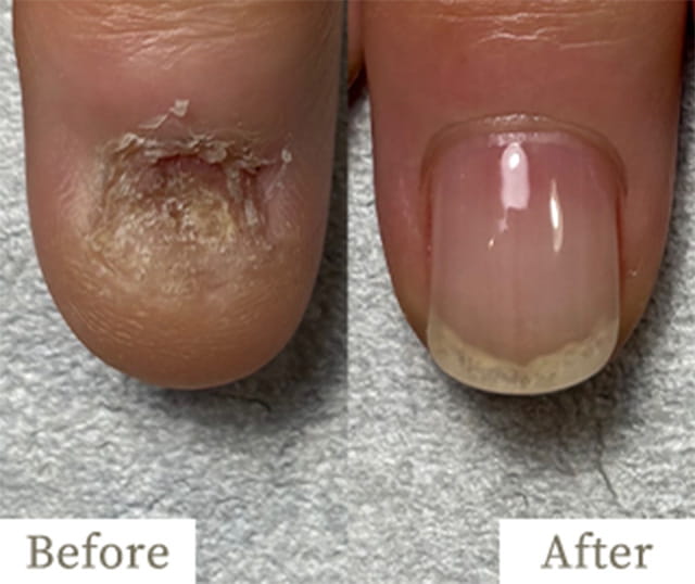 copy1-img - トレフル|明石の深爪矯正ネイルサロン 明石市の深爪矯正専門サロン|深爪・噛み爪・むしり癖でお悩みならトレフル