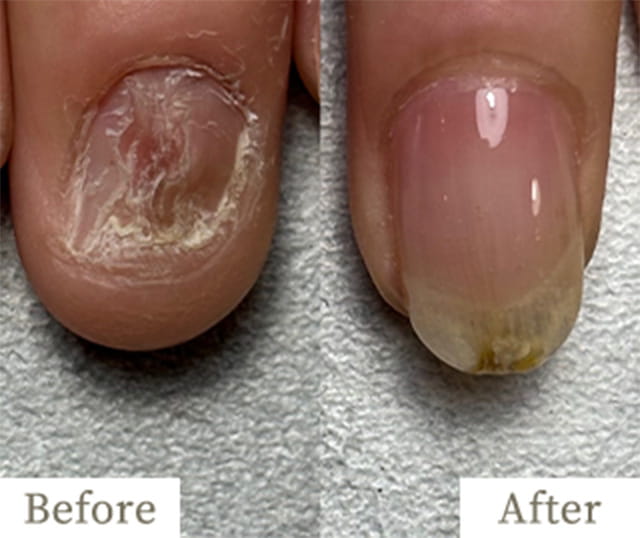 copy2-img - トレフル|明石の深爪矯正ネイルサロン 明石市の深爪矯正専門サロン|深爪・噛み爪・むしり癖でお悩みならトレフル