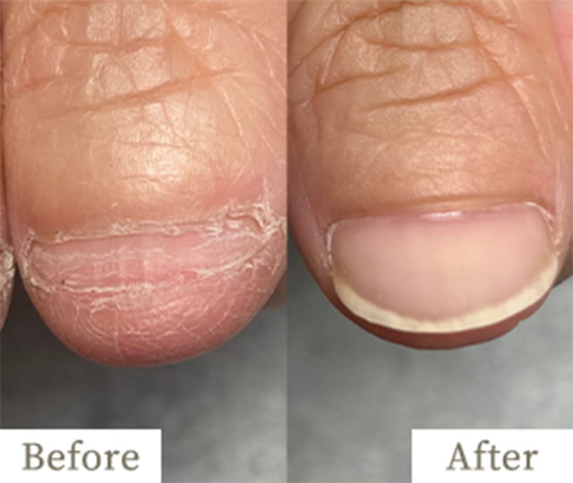 copy5-img - トレフル|明石の深爪矯正ネイルサロン 明石市の深爪矯正専門サロン|深爪・噛み爪・むしり癖でお悩みならトレフル