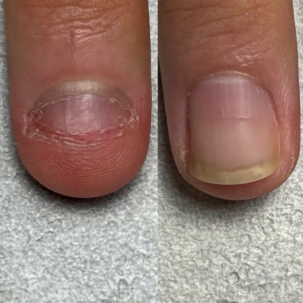 image - トレフル|明石の深爪矯正ネイルサロン