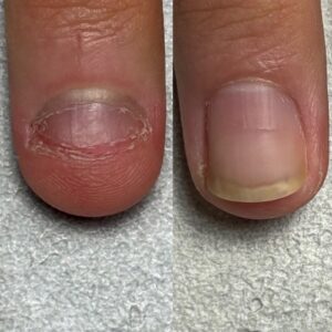 image - トレフル|明石の深爪矯正ネイルサロン