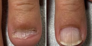 明石市の深爪矯正専門サロン｜深爪・噛み爪・むしり癖でお悩みならトレフル