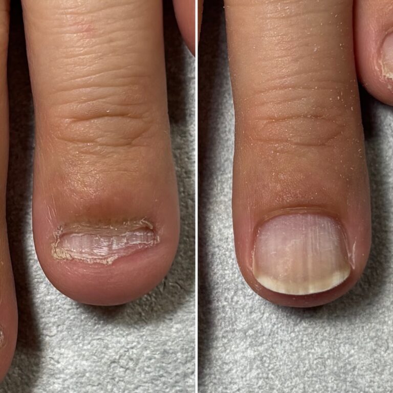 明石市の深爪矯正専門サロン｜深爪・噛み爪・むしり癖でお悩みならトレフル