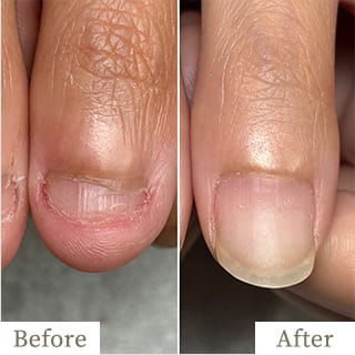 menu-img1 - トレフル|明石の深爪矯正ネイルサロン 明石市の深爪矯正専門サロン|深爪・噛み爪・むしり癖でお悩みならトレフル