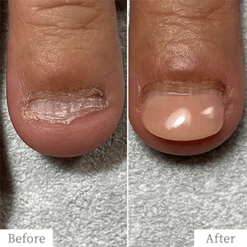 merit1-img - トレフル|明石の深爪矯正ネイルサロン 明石市の深爪矯正専門サロン|深爪・噛み爪・むしり癖でお悩みならトレフル