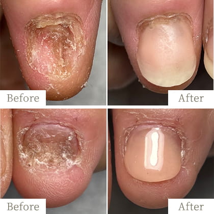 明石市の深爪矯正専門サロン|深爪・噛み爪・むしり癖でお悩みならトレフル - トレフル|明石の深爪矯正ネイルサロン 明石市の深爪矯正専門サロン|深爪・噛み爪・むしり癖でお悩みならトレフル