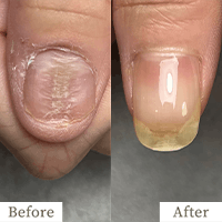 明石市の深爪矯正専門サロン｜深爪・噛み爪・むしり癖でお悩みならトレフル