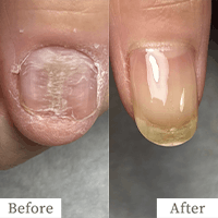 明石市の深爪矯正専門サロン｜深爪・噛み爪・むしり癖でお悩みならトレフル