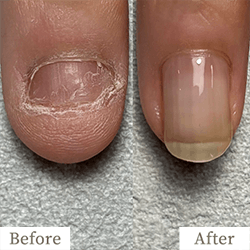 review-01-img2 - トレフル|明石の深爪矯正ネイルサロン 明石市の深爪矯正専門サロン|深爪・噛み爪・むしり癖でお悩みならトレフル