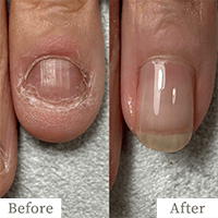 明石市の深爪矯正専門サロン｜深爪・噛み爪・むしり癖でお悩みならトレフル