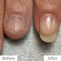 明石市の深爪矯正専門サロン｜深爪・噛み爪・むしり癖でお悩みならトレフル