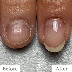 review-02-img2 - トレフル|明石の深爪矯正ネイルサロン 明石市の深爪矯正専門サロン|深爪・噛み爪・むしり癖でお悩みならトレフル