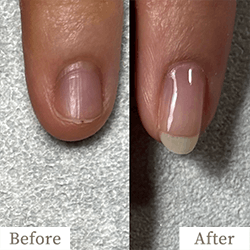 review-02-img3 - トレフル|明石の深爪矯正ネイルサロン 明石市の深爪矯正専門サロン|深爪・噛み爪・むしり癖でお悩みならトレフル