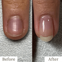 明石市の深爪矯正専門サロン｜深爪・噛み爪・むしり癖でお悩みならトレフル