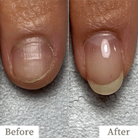 明石市の深爪矯正専門サロン｜深爪・噛み爪・むしり癖でお悩みならトレフル