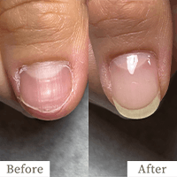 明石市の深爪矯正専門サロン｜深爪・噛み爪・むしり癖でお悩みならトレフル