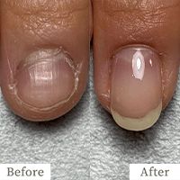 明石市の深爪矯正専門サロン｜深爪・噛み爪・むしり癖でお悩みならトレフル