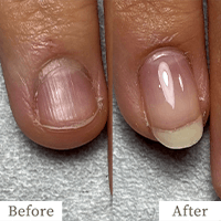 明石市の深爪矯正専門サロン｜深爪・噛み爪・むしり癖でお悩みならトレフル