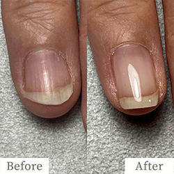 review-03-img2 - トレフル|明石の深爪矯正ネイルサロン 明石市の深爪矯正専門サロン|深爪・噛み爪・むしり癖でお悩みならトレフル