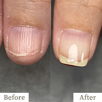 明石市の深爪矯正専門サロン｜深爪・噛み爪・むしり癖でお悩みならトレフル